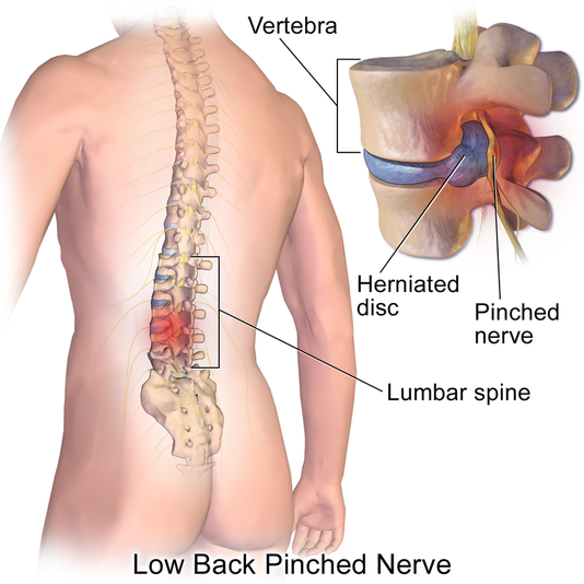 https://www.release-the-pain.com/uploads/4/4/6/3/4463463/herniatedlumbardisc-low-back-pain.png?534